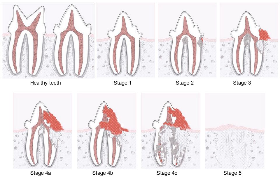 tooth resorption stages VSL